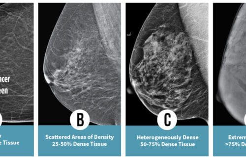 Breast Density