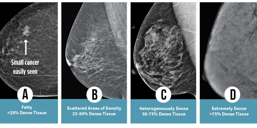 Breast Density