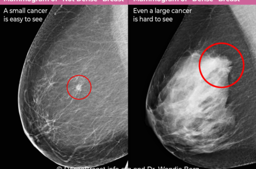 Breast density