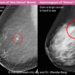 Breast density