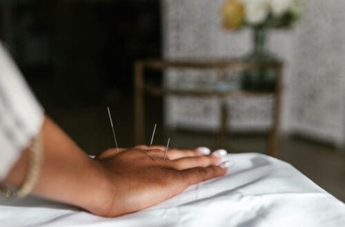 acupuncture